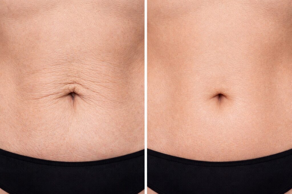 סקולפטרה לפני ואחרי באזור הבטן והטבור לשיפור מרקם והידוק העור