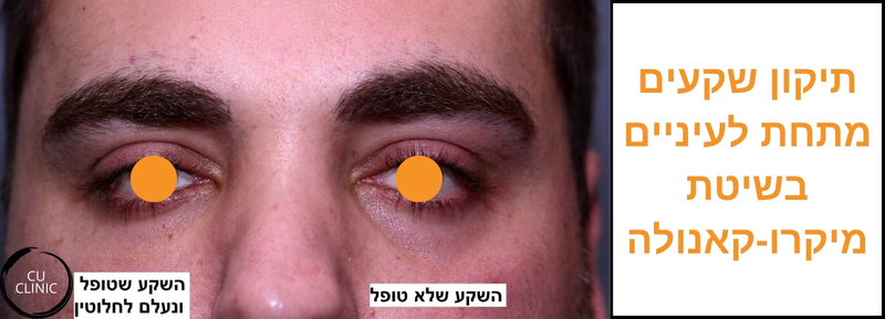 טיפול מילוי שקעים מתחת לעינים